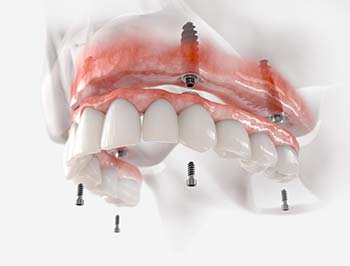 Dental Implants: The Cost and Benefits