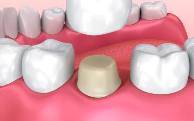 How Much Does a Dental Crown Cost?