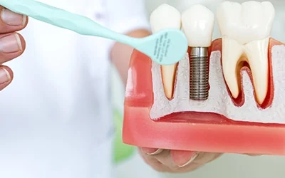 Do Dental Implants Hurt?