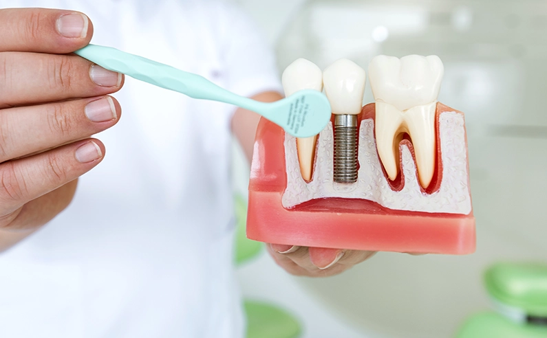 How Much Does a Single Tooth Implant Cost Without Insurance?