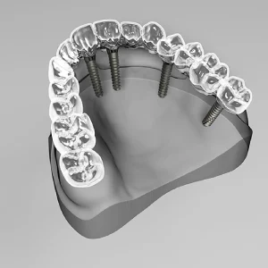 All-On-6 Dental Implants