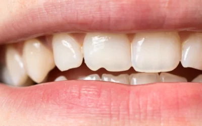 How much does it cost to fix a chipped tooth?