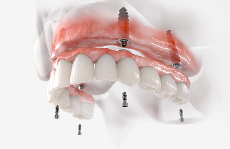 Same-Day Dental Implants: Are They Right For You?