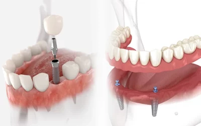Dental Implants vs Dentures: Which is Better for You?