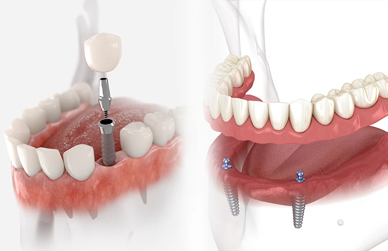 Dental Implants vs Dentures: Which is Better for You?