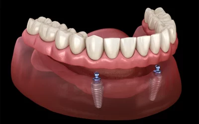 Options for Full Mouth Tooth Replacement